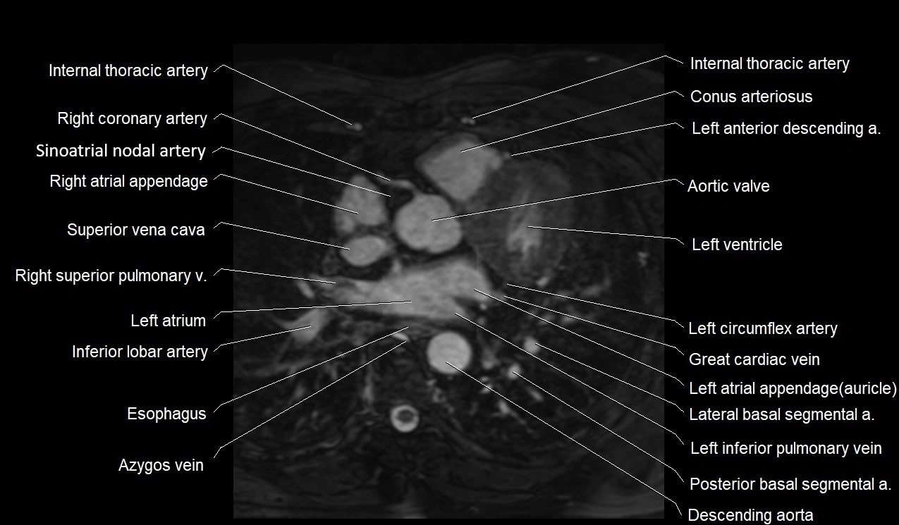 MRI heart coronary arteries and coronary veins anatomy axial image 17.webp